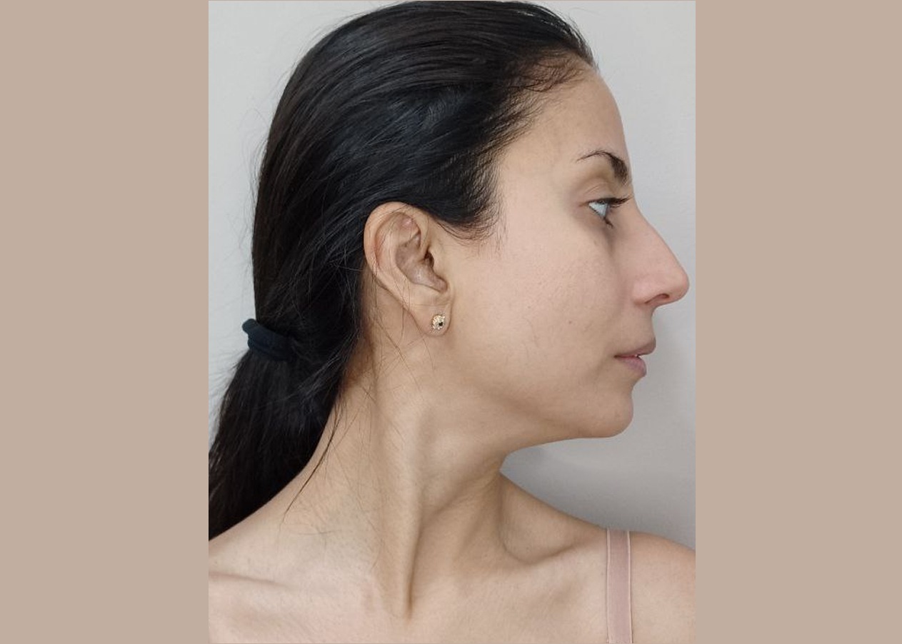 Buccal massage before 2 444 Buccal massage in Las Vegas