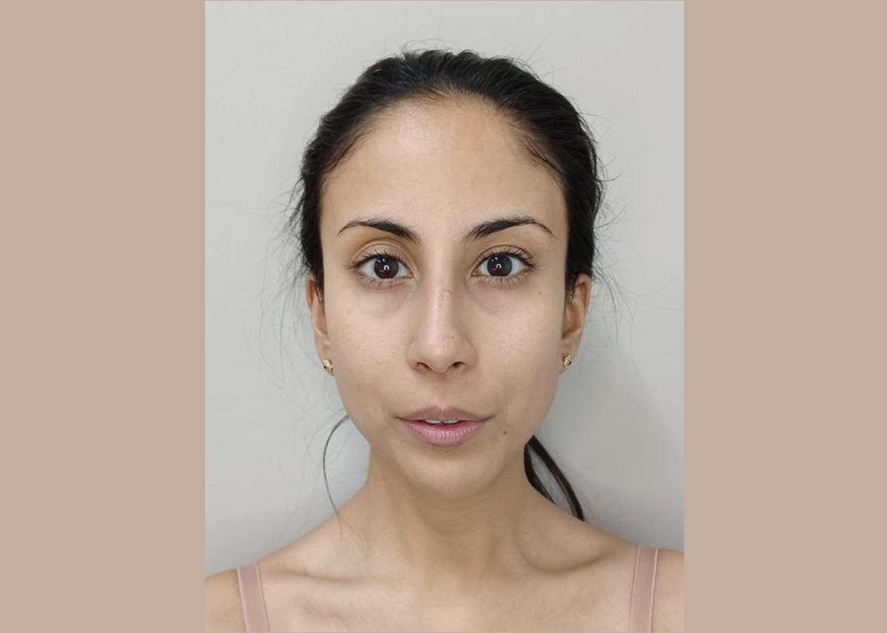 Buccal massage before 333 Buccal massage in Las Vegas