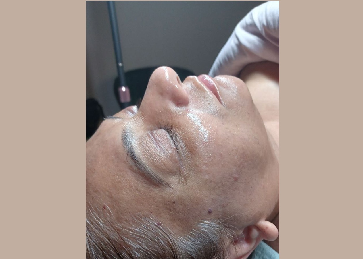 Hydra facial Las Vegas Hydra facial Las Vegas