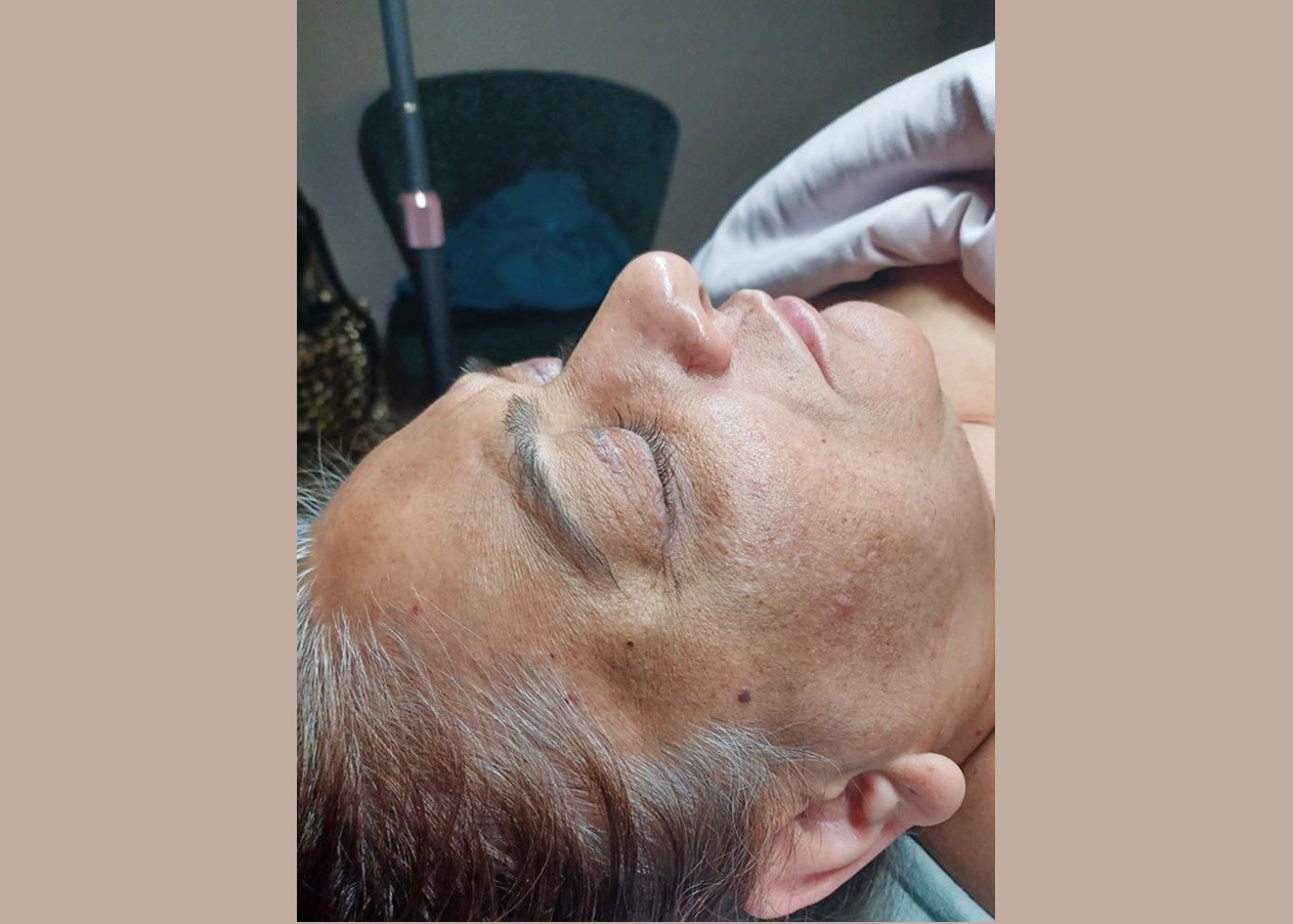 Hydra facial Las Vegas Hydra facial Las Vegas