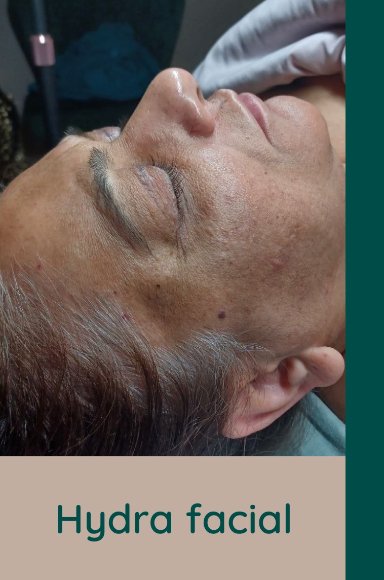 Hydra facial in las vegas
